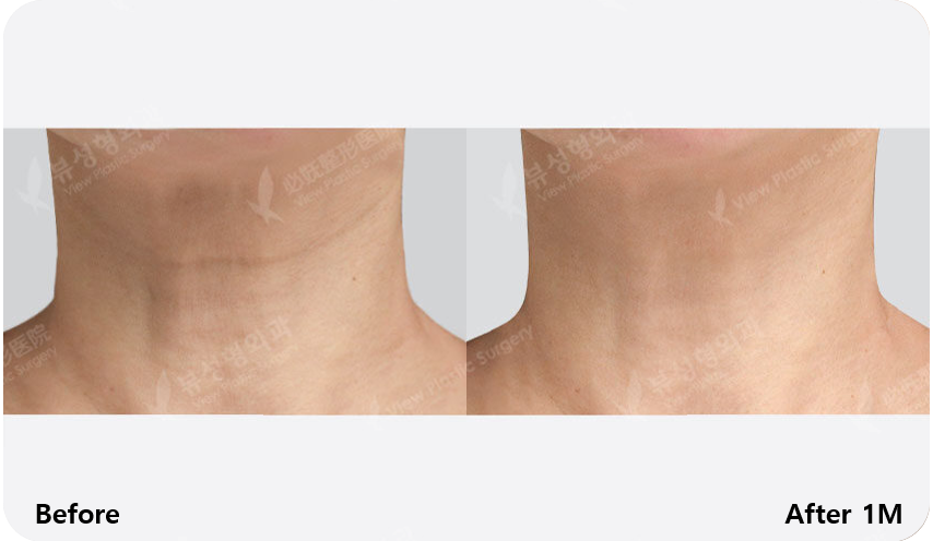 view-skin-clinic-before-after-02