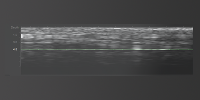 ultherapy list 02 mo