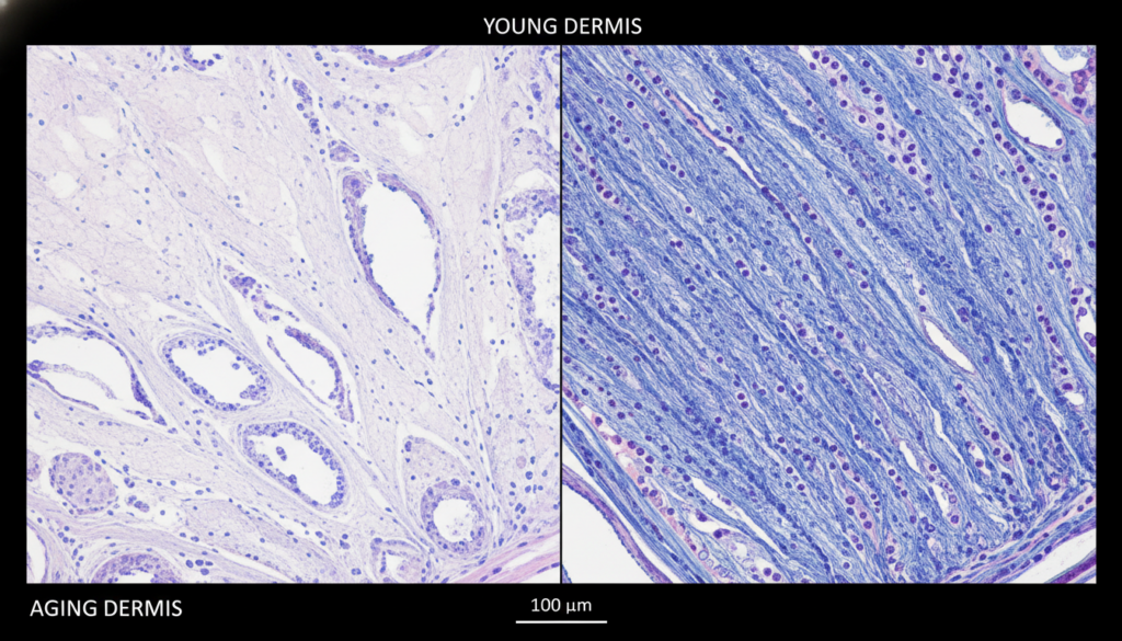 Young dermis vs aging dermis comparison showing differences in skin tissue structure under a microscope